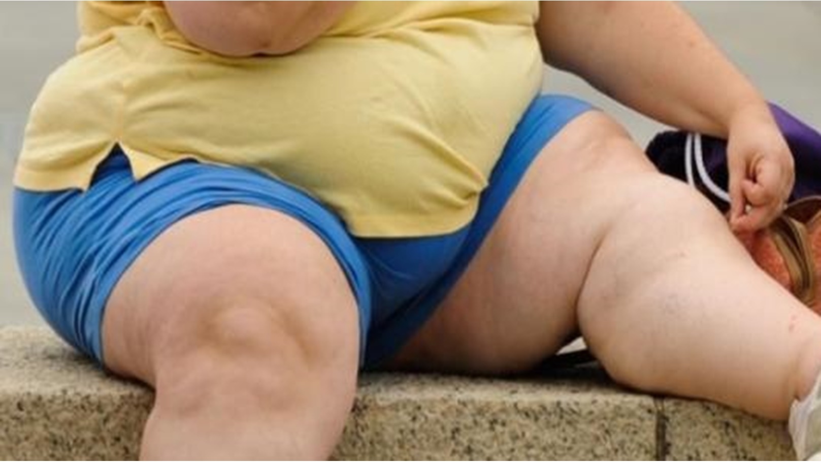 السمنة المفرطة