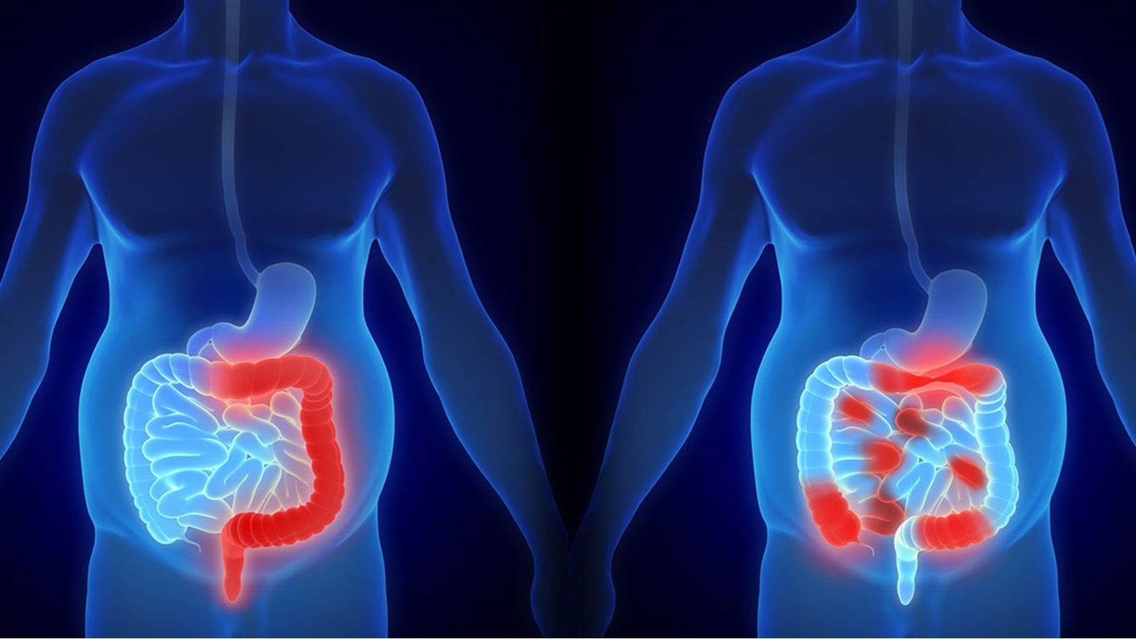 سرطان المستقيم